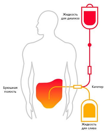 Диализ как делают фото