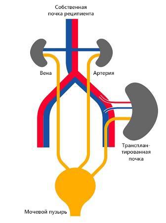 Трансплантация почки схема